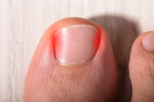 Causes and Risk Factors for Ingrown Toenails