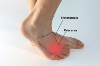 Understanding Morton’s Neuroma