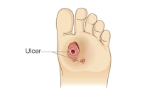 Definition and Symptoms of a Diabetic Foot Wound