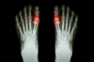 Buildup of Tophi in Gout