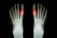 Buildup of Tophi in Gout