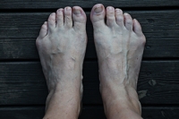What You Need to Know About a Tailors Bunion