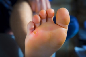 Corns or Calluses?